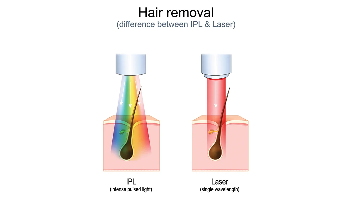 a vector depiction of the difference between laser hair removal and IPL